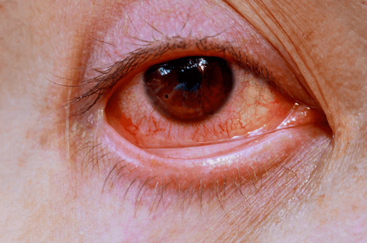 4. Glaucoma-1