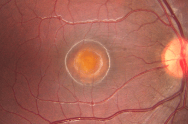 6. Distrofias retinianas