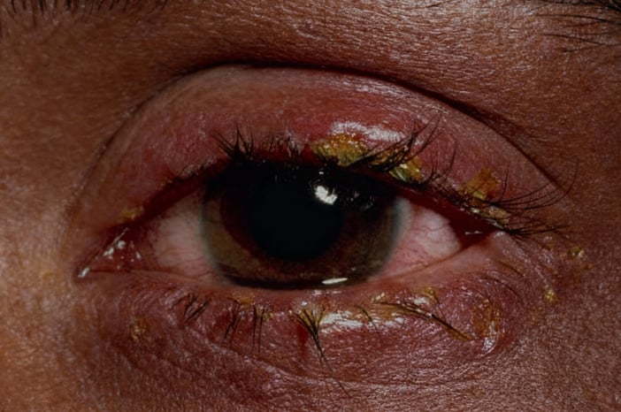 clasificacion-blefaritis