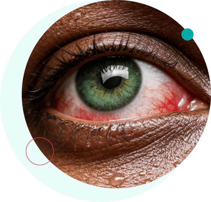 conjuntivitis conjuntivitis