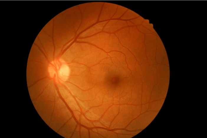 degeneracion-macular-que-es
