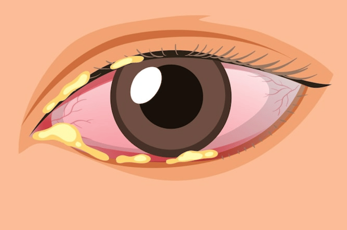 infeccion-interna-ocular