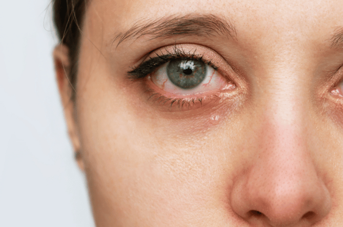ojos-secos-embarazo-causas