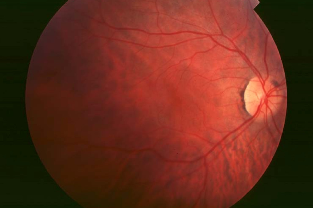 retinitis-como-afecta-la-vision