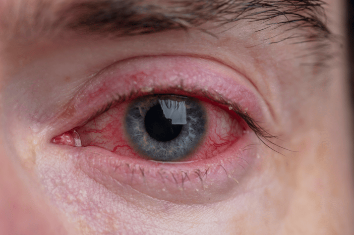 tipos-de-conjuntivitis